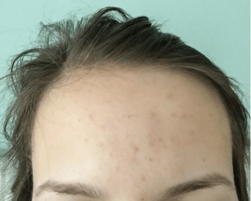 How I Cleared the Tiny Bumps on My Forehead Before Picture 2