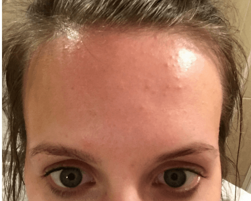 How I Cleared My Tiny Bumps On Forehead Once For All