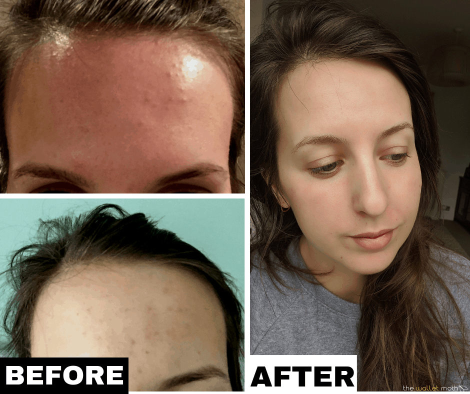 How I Cleared The Tiny Bumps On Forehead | How I Cleared My Acne